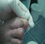 Hongos en los pies hongos en la ua del pie onicomicosis tratamiento avulison quimica